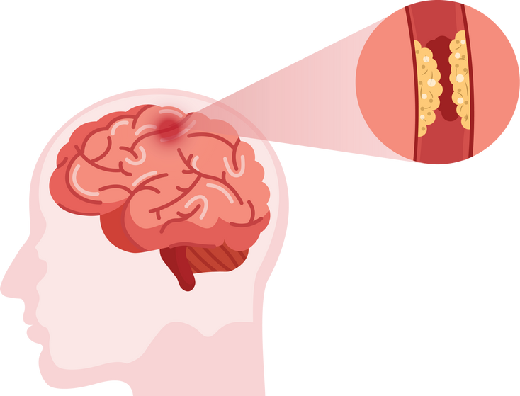 Stroke disease. Hemorrhagic brain stroke concept. Apoplexy,